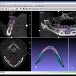 نرم افزار داندانپزشکی دنتال GuideMia CAD CAM Dental ویرایش STL DICOM